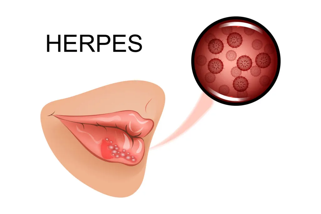 Illustration of infection on a womans lips known as oral herpes
