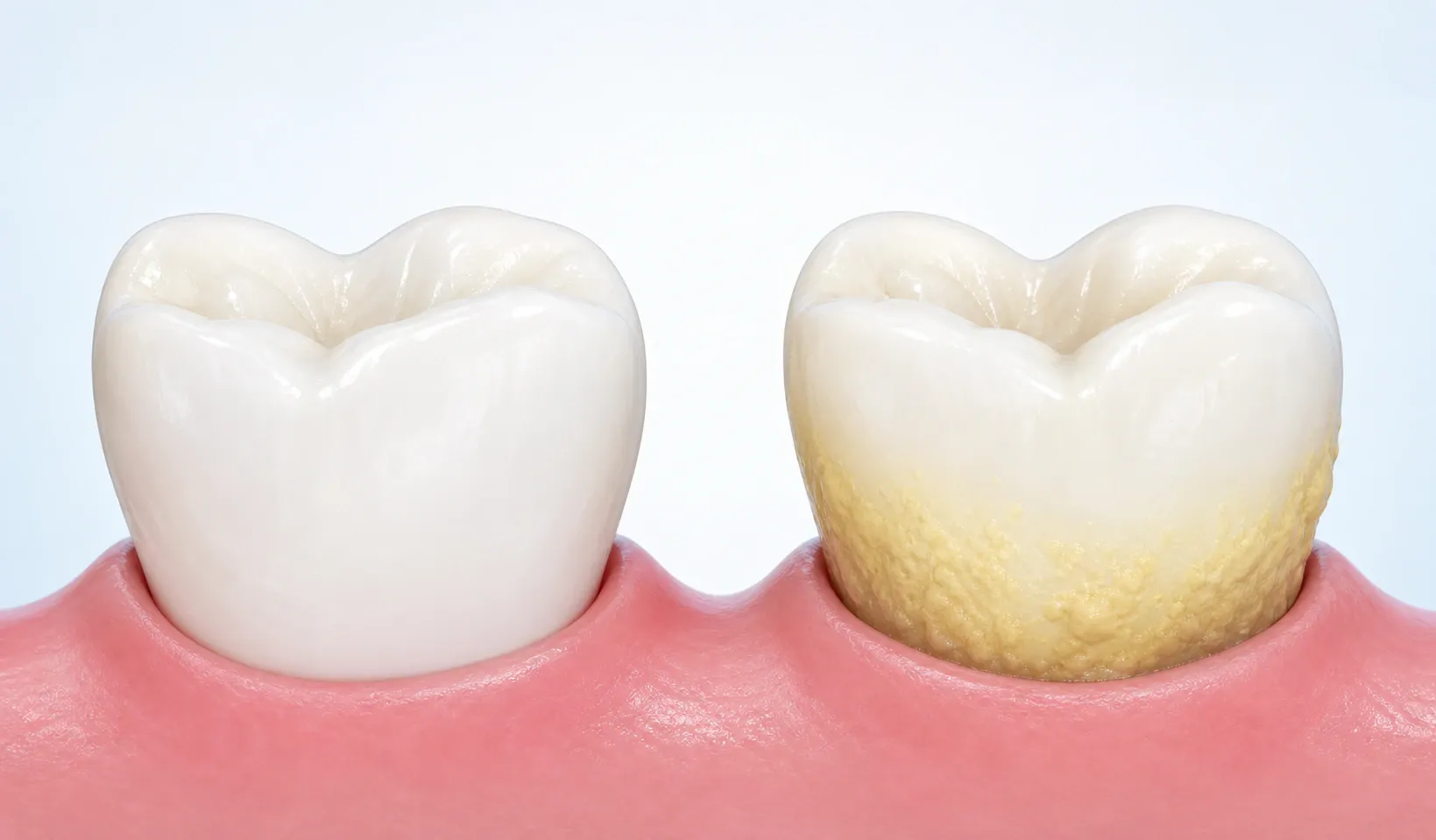 Illustration showing tooth with plaque and healthy tooth comparision nm 1126