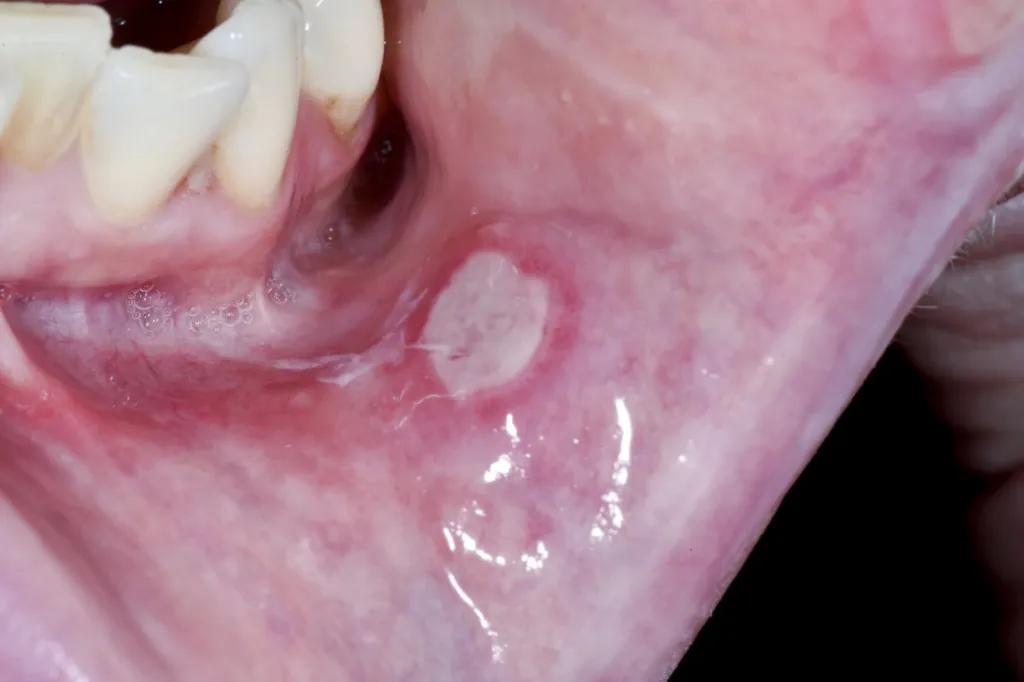 Close-up of the inside of a person's mouth showing a white ulcer on the pinkish-red inner cheek adjacent to the lower teeth.