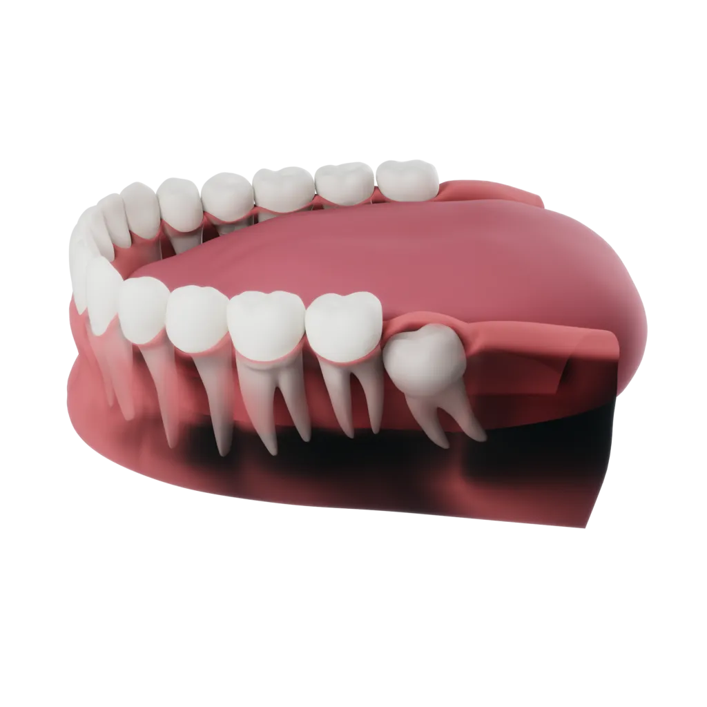 Impacted Wisdom Teeth
