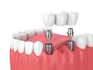 Implant supported bridge NewMouth