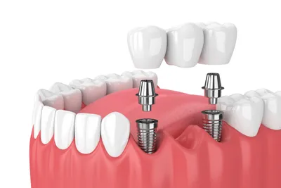 What's the Average Cost of a Dental Bridge?