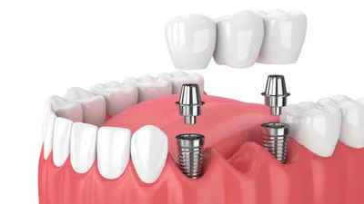 What's the Average Cost of a Dental Bridge?