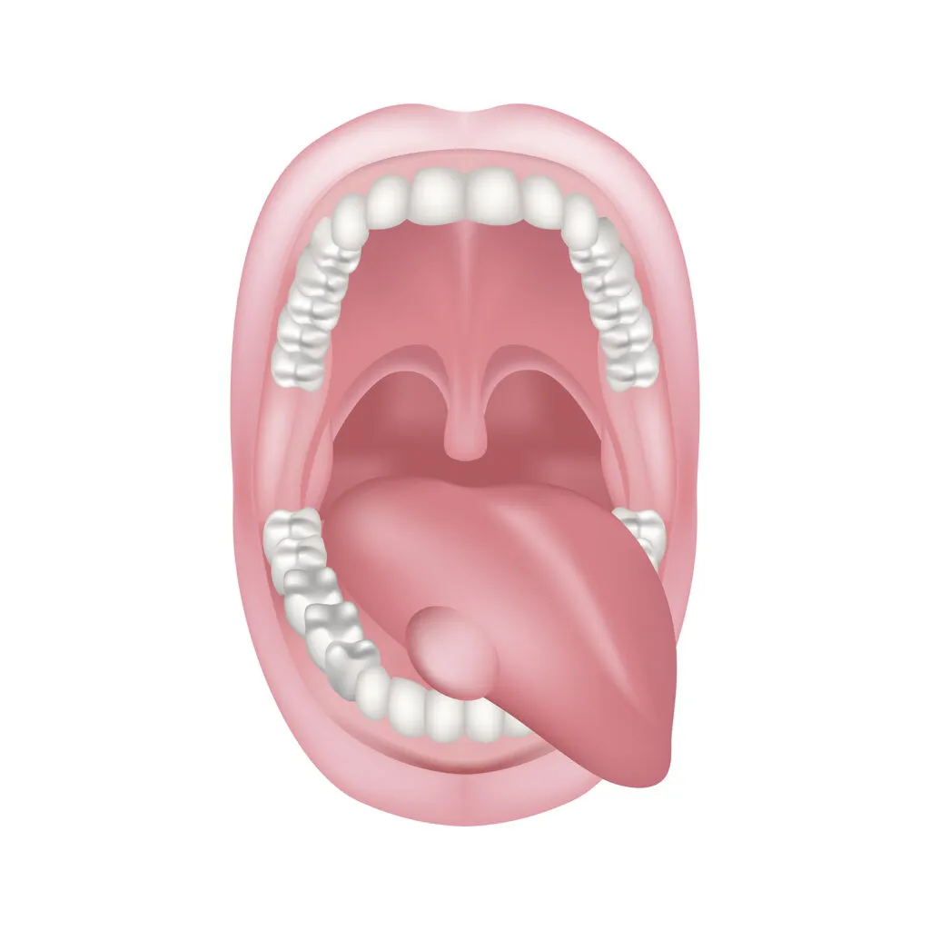 Inflamed tongue bump