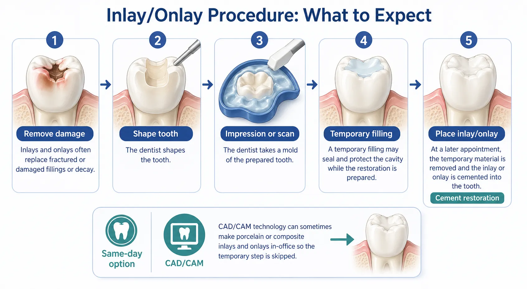 Inlay onlay procedure workflow v1