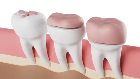 Dental Inlays and Onlays