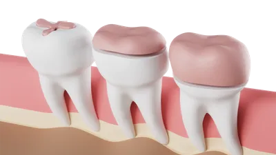 Dental Inlays and Onlays