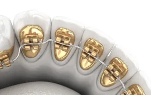 Lingual bracesNewMouth