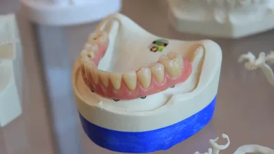 Hybrid Dentures