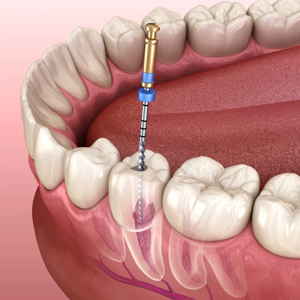 Medically accurate 3d render of an endodontic root canal treatment process