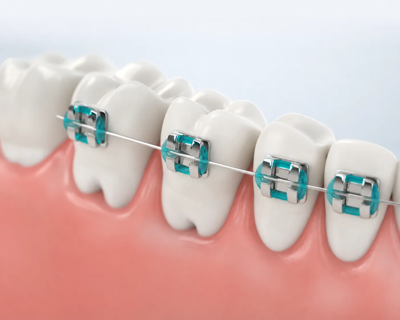 Metal bracesNewMouth