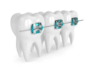 Metal bracesNewMouth