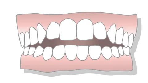 What is an Open Bite?