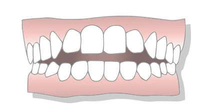 What is an Open Bite?