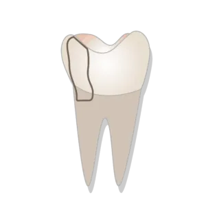 Oral health fractured cusp google doc 1