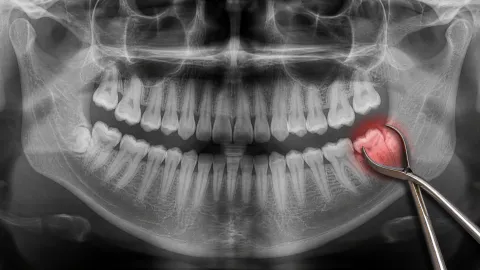 Can Wisdom Teeth Grow Back?