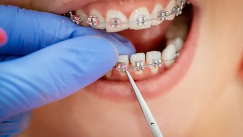 How Long Does It Take to Put On Braces?