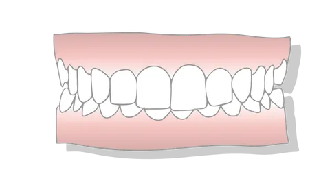 Types of Underbites: Causes, Risk Factors & Treatment Options