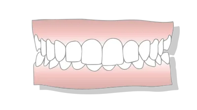 Types of Underbites: Causes, Risk Factors & Treatment Options