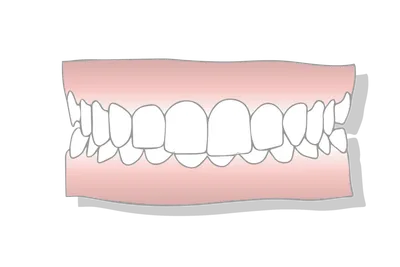 Types of Underbites: Causes, Risk Factors & Treatment Options