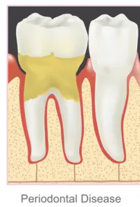 Periodonal disease