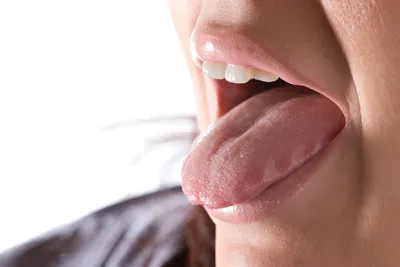 Warts on the Tongue