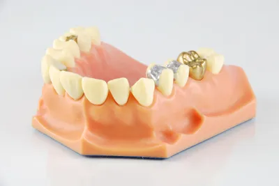 How Long Does a Gold Crown Last?