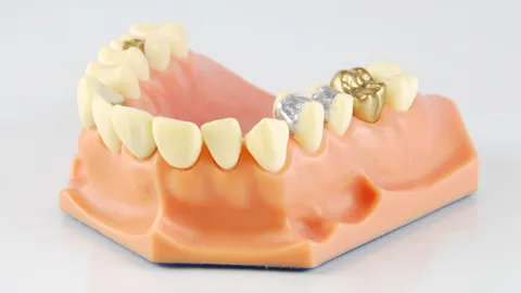 How Long Does a Gold Crown Last?