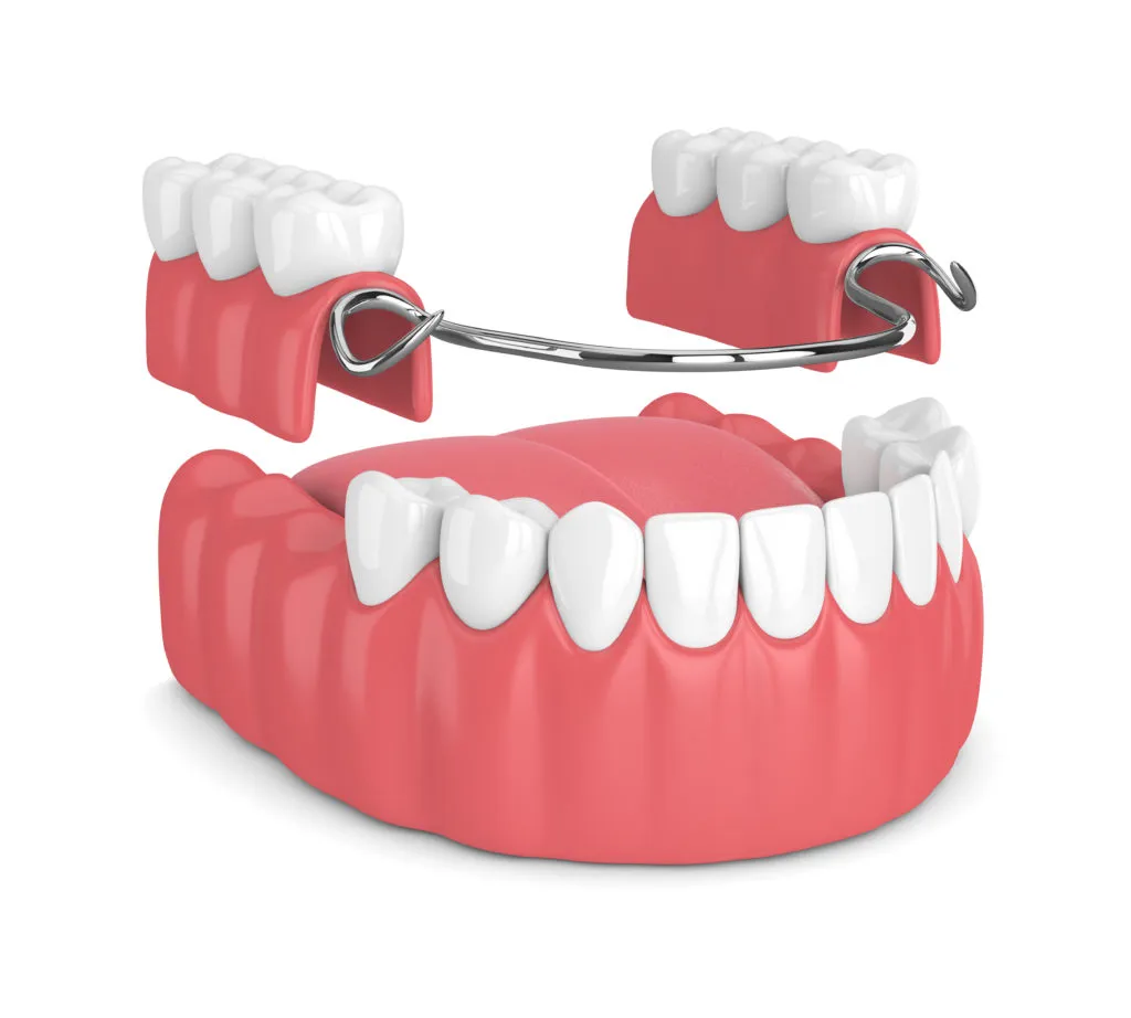 Removable partial denture NewMouth
