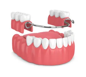 Removable partial denture NewMouth