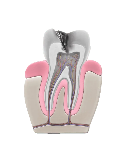 Root canal procedure step1