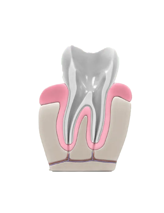 Root canal procedure step3