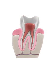 Root canal procedure step4