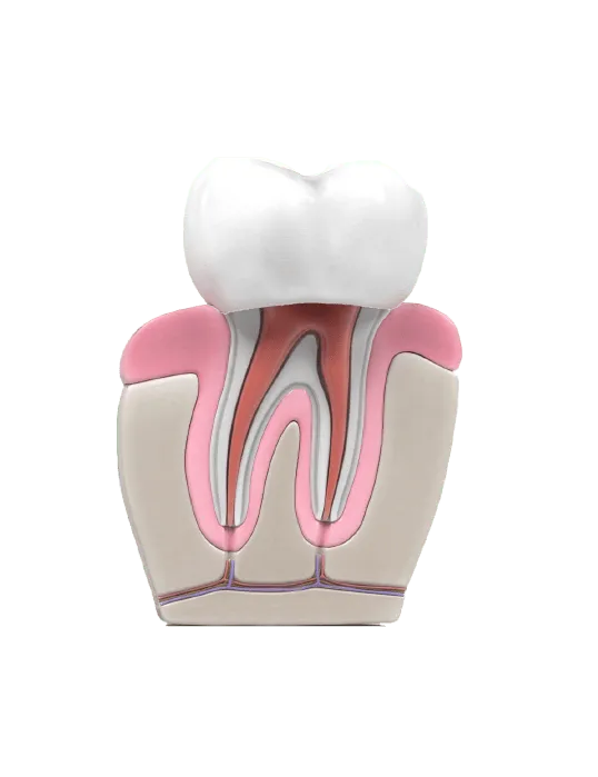 Root canal procedure step5