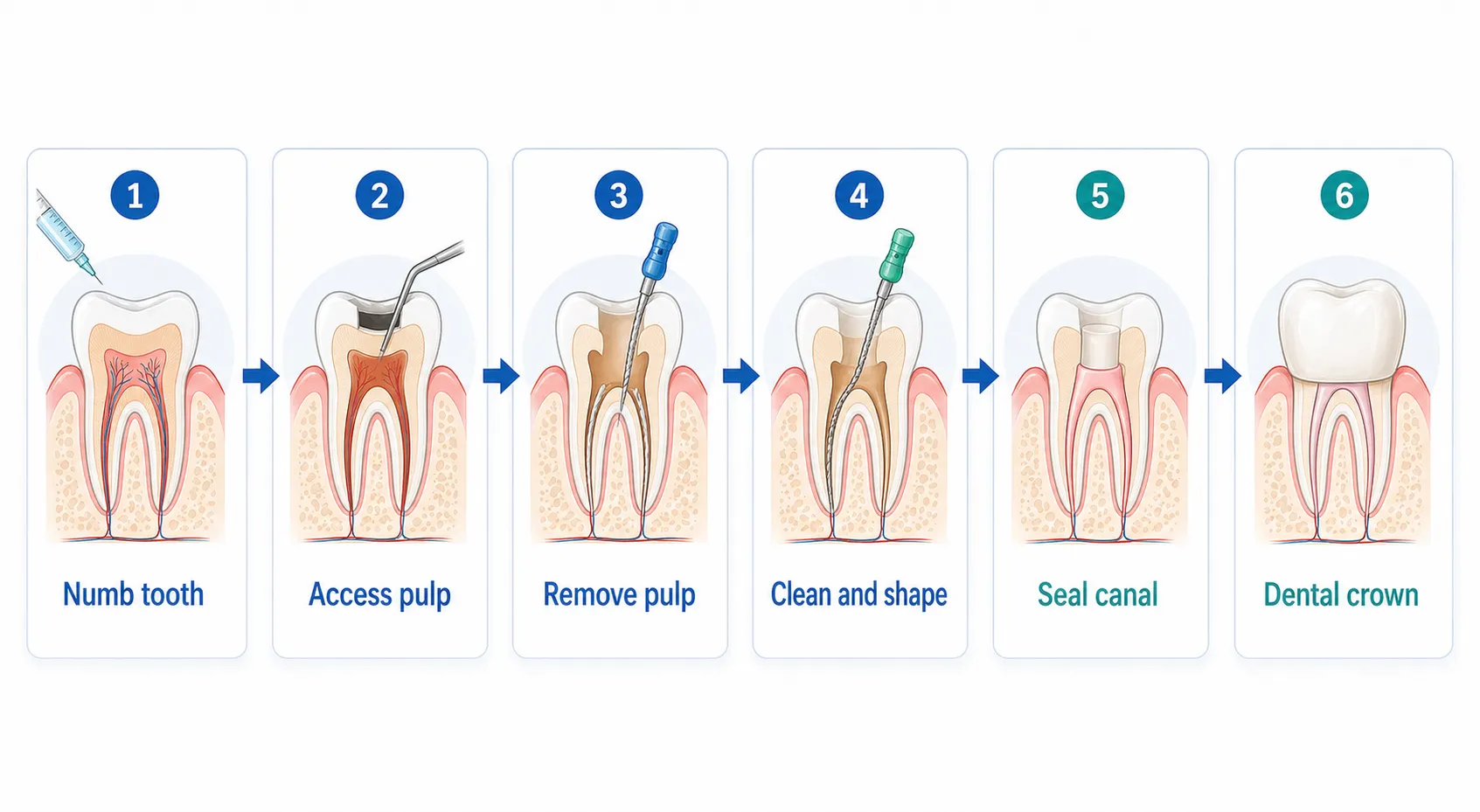 Root canal procedure steps v1