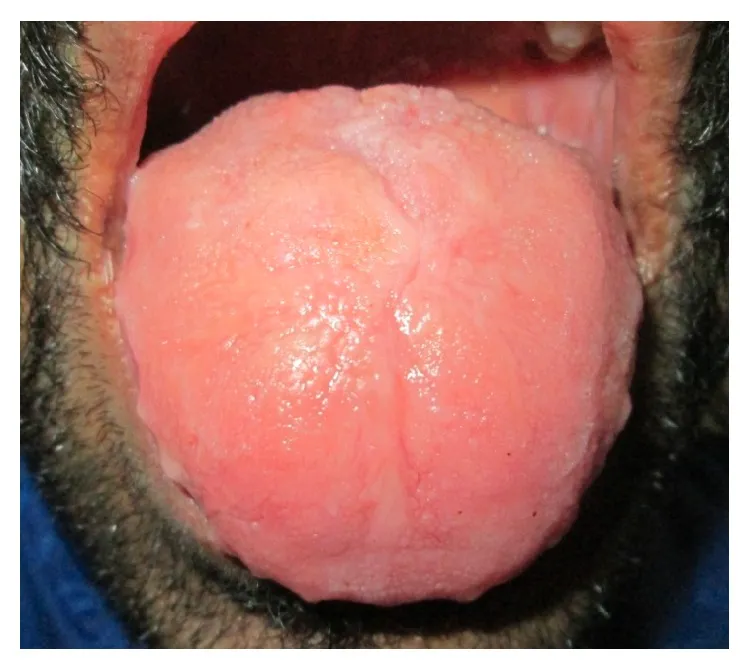 A close-up view of a person's mouth opened wide, showing the tongue protruding and appearing swollen and pink.