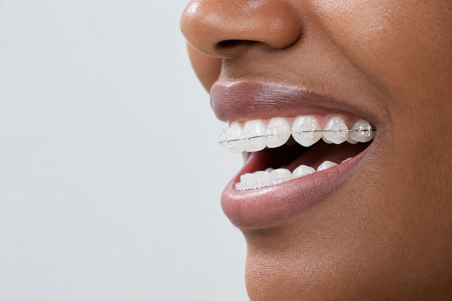 Side view picture of womans smile with clear dental braces on nm 1136