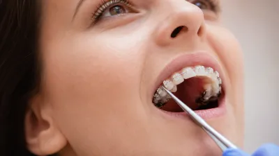 Six Month Smiles Aligners Review (2026)