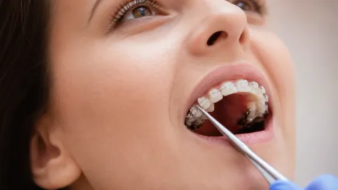 Six Month Smiles Aligners Review (2026)