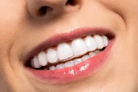 Smiling woman invisalign clear aligners