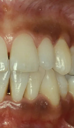 Close-up of a human mouth showing upper and lower teeth in a bite position, with visible gums.