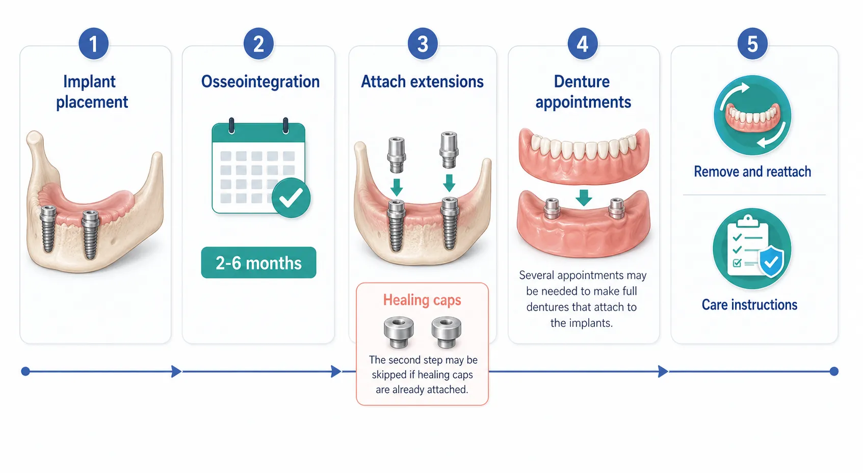 Snap in denture implant process v1