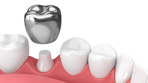 What to Know About Dental Crowns