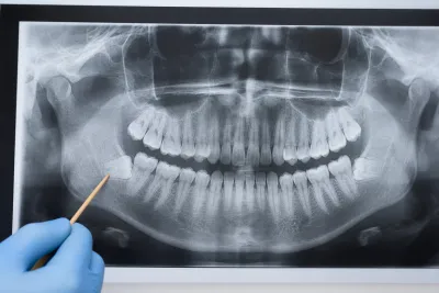 Impacted Wisdom Teeth: Symptoms, Diagnosis & Treatment