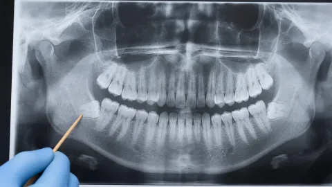 Impacted Wisdom Teeth: Symptoms, Diagnosis & Treatment