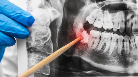 Impacted Wisdom Teeth: Symptoms, Diagnosis &amp; Treatment
