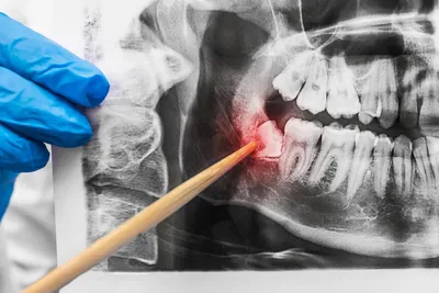 Impacted Wisdom Teeth: Symptoms, Diagnosis &amp; Treatment