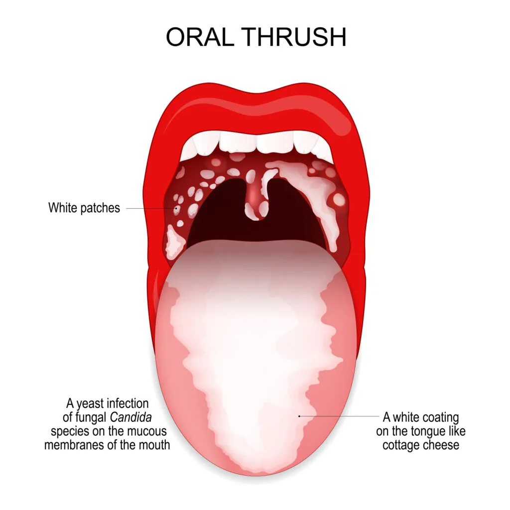 Symptoms of oral thrush