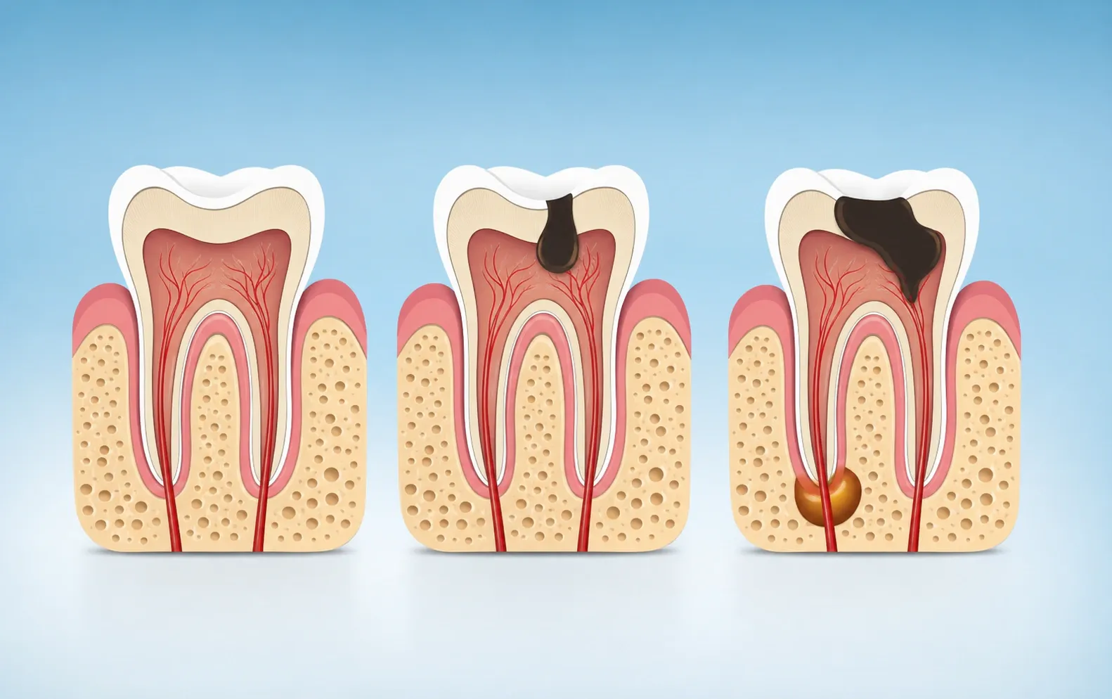 Tooth abscess progression through vector illustration nm 1140