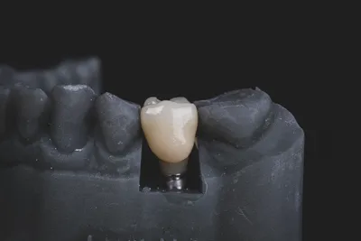 How Much Are Dental Implants & How Can You Pay for Them?
